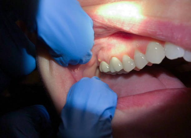 Best Dentist for Tooth Abscess  in Thiells, NY